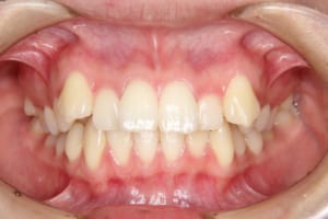 上の犬歯が八重歯、前歯が突出しています。